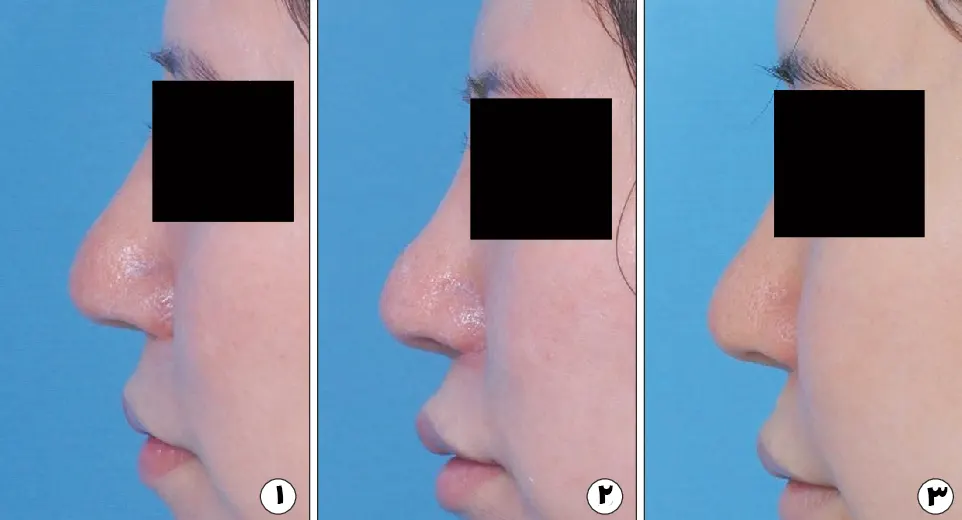 قبل و بعد از تزریق کورتون به بینی