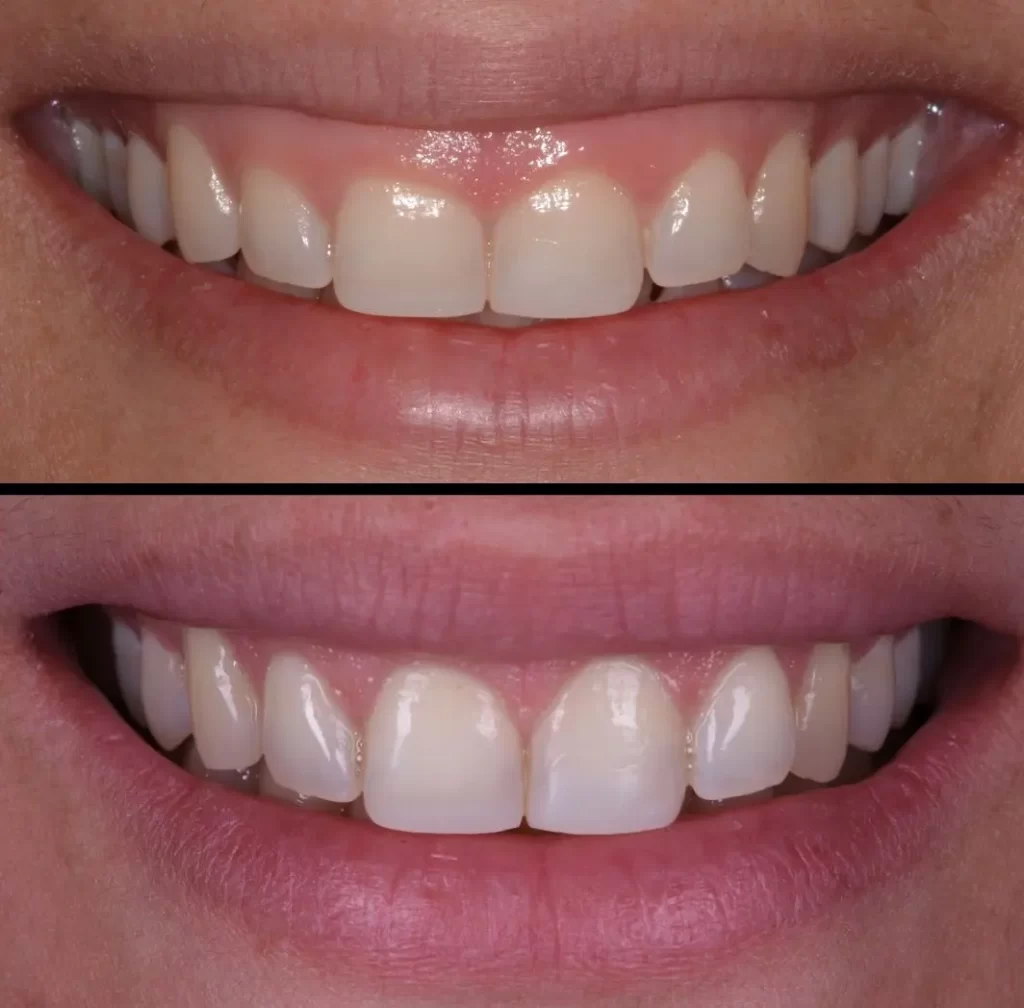 قبل و بعد از درمان لبخند لثه ای با تزریق بوتاکس